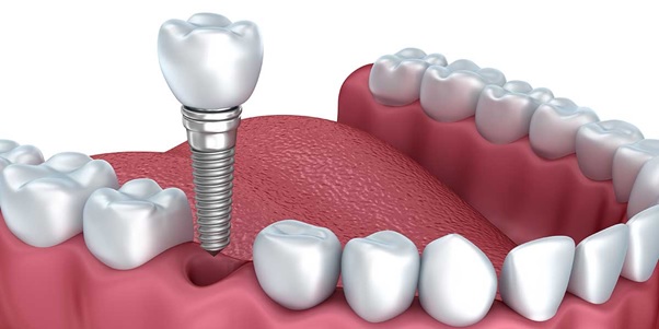 Phương pháp trồng răng implant