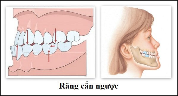 Tình trạng khớp cắn ngược ở trẻ