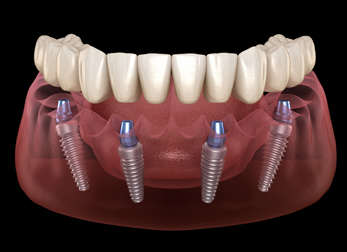 Cấy ghép Implant All On 4 đặc biệt hiệu quả, hạn chế đau đớn.