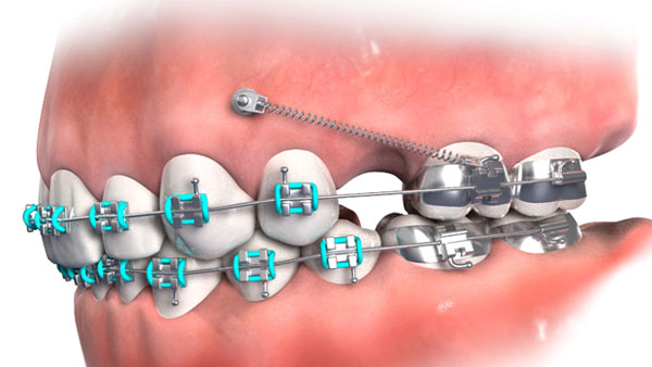 Khí cụ chỉnh nha minivis