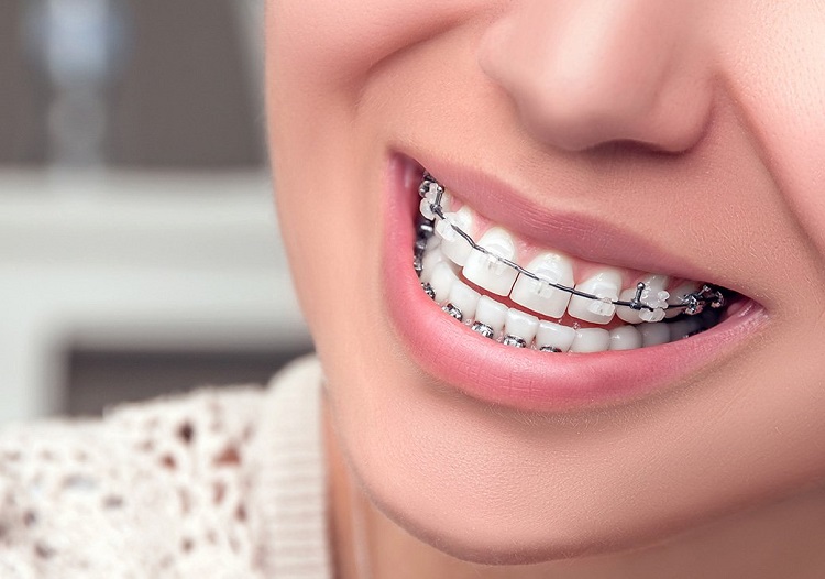 Bọc răng sứ có thể niềng răng được không là thắc mắc chung của rất nhiều người