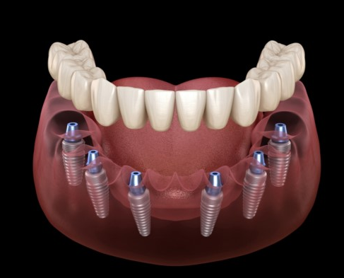 Cấy ghép Implant